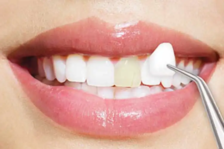 لمینت اقساطی