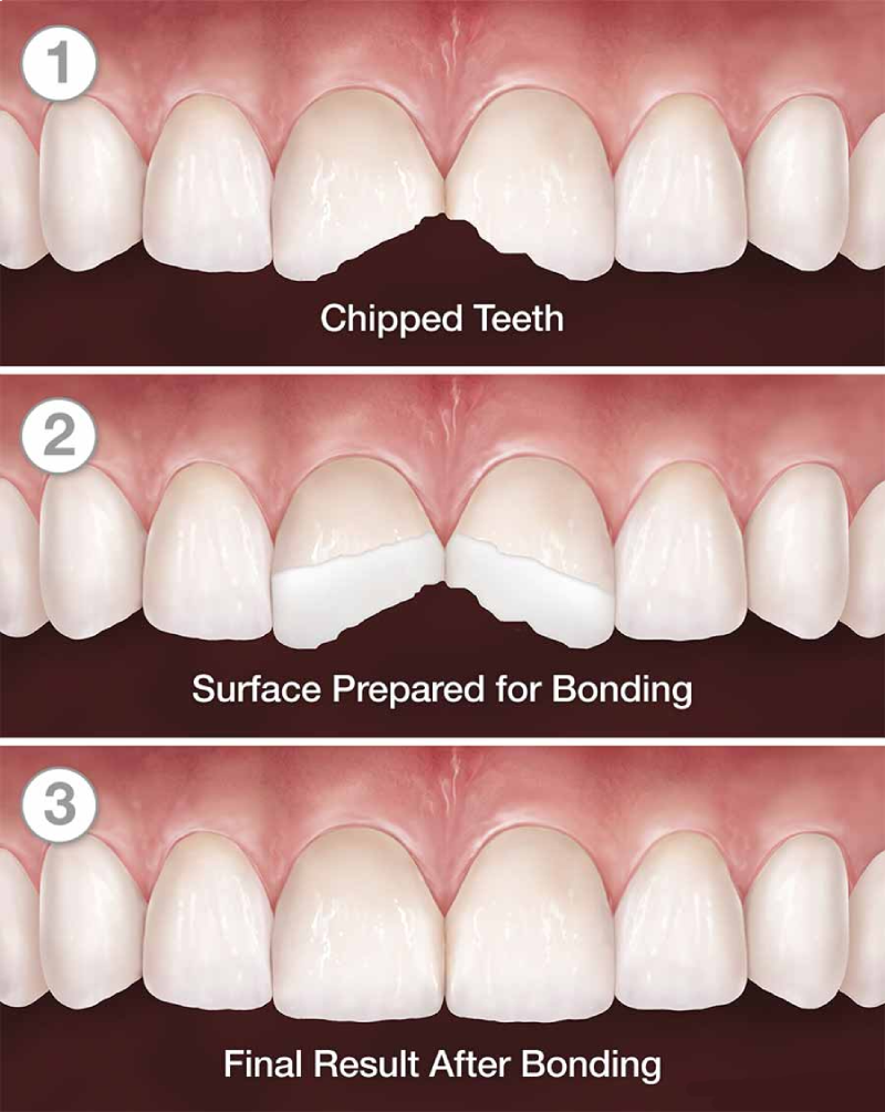 باندینگ دندان