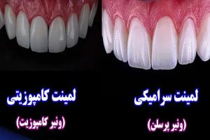 تفاوت کامپوزیت با لمینت