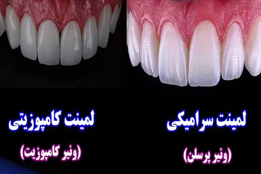 تفاوت کامپوزیت با لمینت