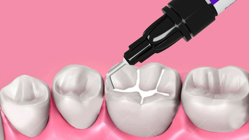 سیلانت دندان