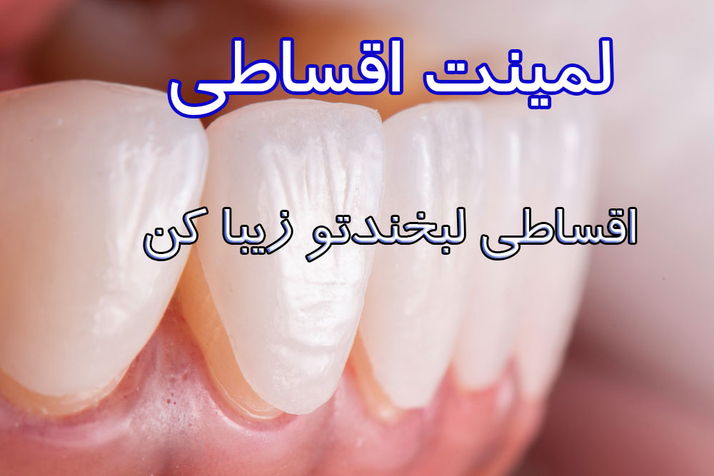 لمینت اقساطی